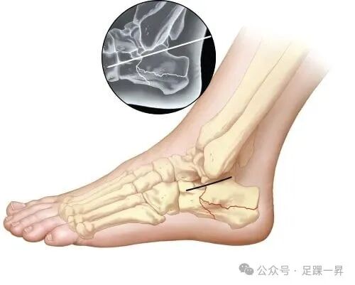 手术技巧｜改良跗骨窦入路增加跟骨体外侧及距下关节显露范围