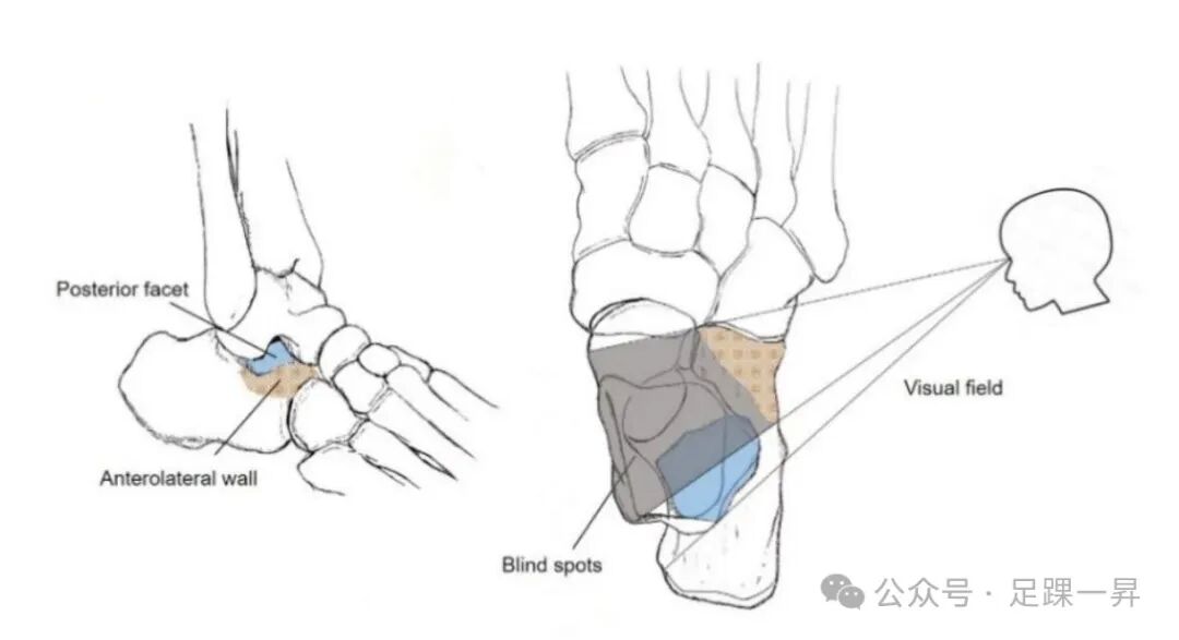 手术技巧｜改良跗骨窦入路增加跟骨体外侧及距下关节显露范围