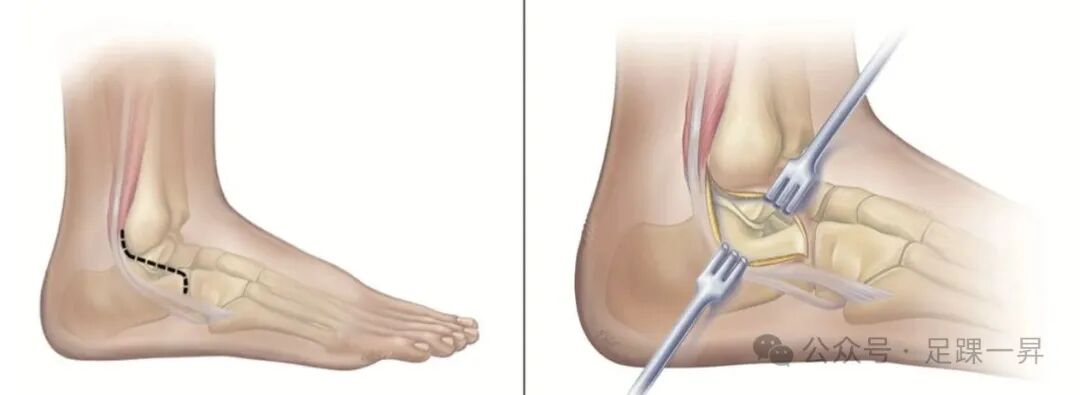 手术技巧｜改良跗骨窦入路增加跟骨体外侧及距下关节显露范围