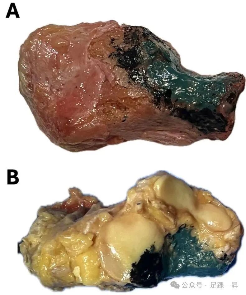 手术技巧｜改良跗骨窦入路增加跟骨体外侧及距下关节显露范围