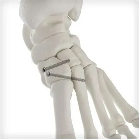 Lisfranc损伤螺钉固定后复位丢失：螺钉类型是否有影响？