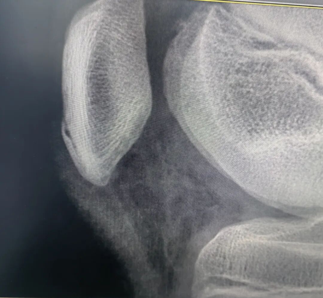 髌骨下极的正常变异【副骨化中心】，误诊陷阱要注意！