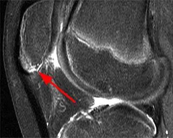 髌骨下极的正常变异【副骨化中心】，误诊陷阱要注意！