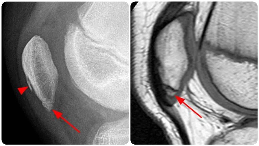 髌骨下极的正常变异【副骨化中心】，误诊陷阱要注意！