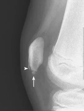 髌骨下极的正常变异【副骨化中心】，误诊陷阱要注意！