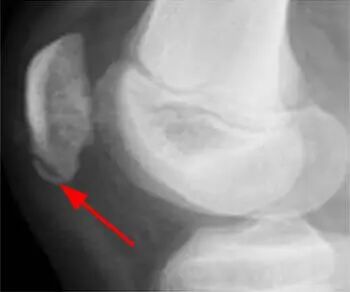 髌骨下极的正常变异【副骨化中心】，误诊陷阱要注意！