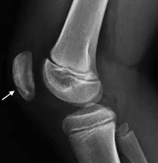 髌骨下极的正常变异【副骨化中心】，误诊陷阱要注意！