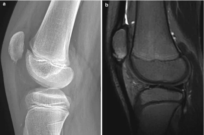 髌骨下极的正常变异【副骨化中心】，误诊陷阱要注意！