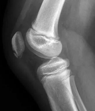 髌骨下极的正常变异【副骨化中心】，误诊陷阱要注意！