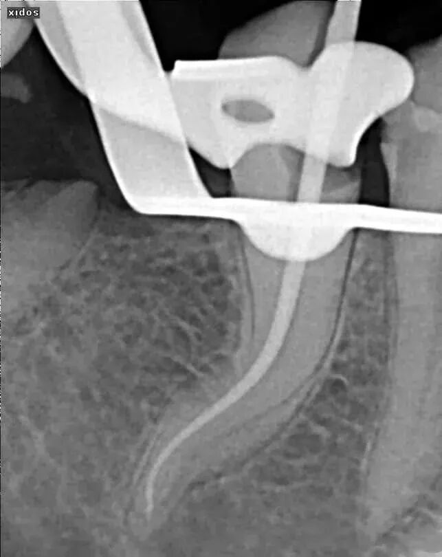让80%的牙医都头大的根管，你敢做吗？