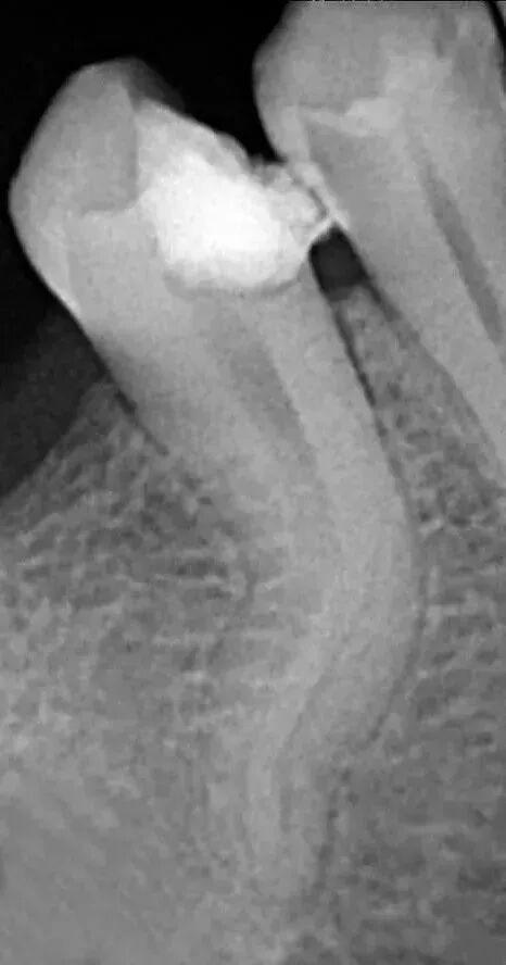 让80%的牙医都头大的根管，你敢做吗？