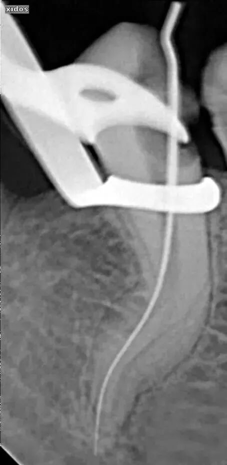 让80%的牙医都头大的根管，你敢做吗？