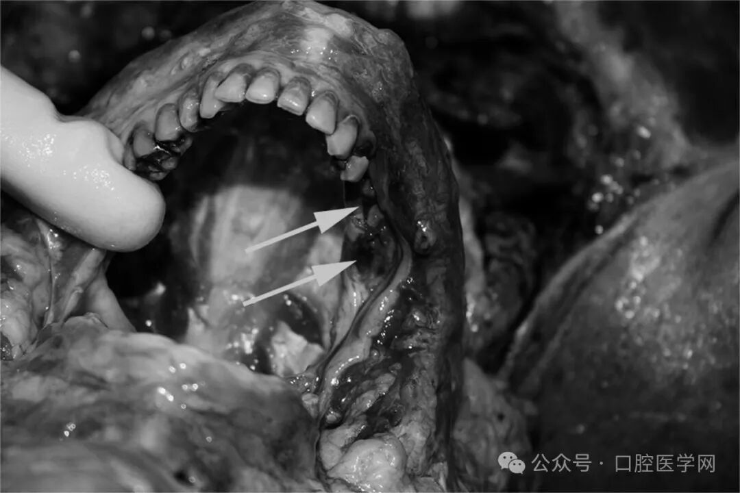 警惕！这种疾病拔牙后有可能导致死亡！