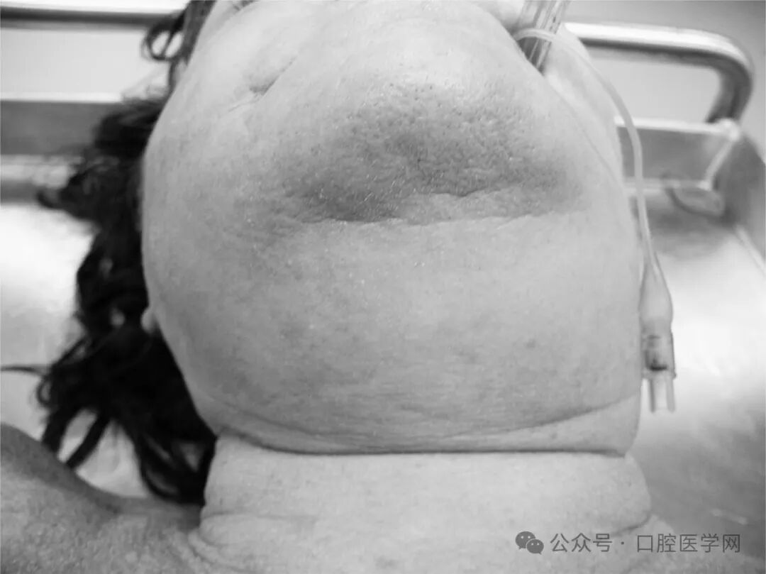 警惕！这种疾病拔牙后有可能导致死亡！