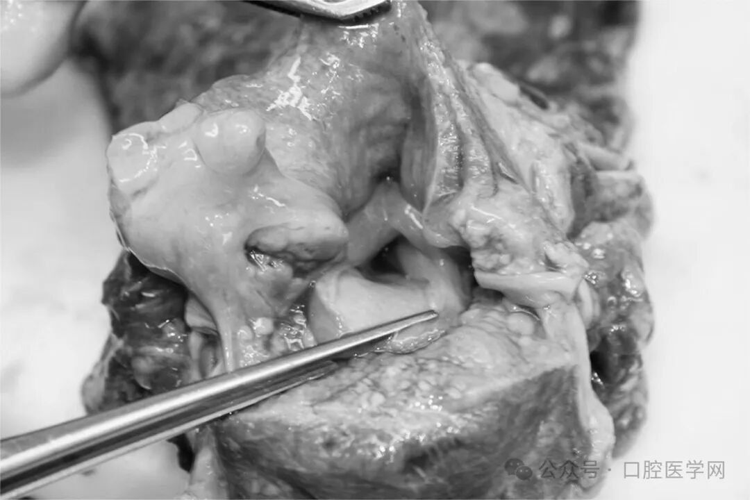 警惕！这种疾病拔牙后有可能导致死亡！