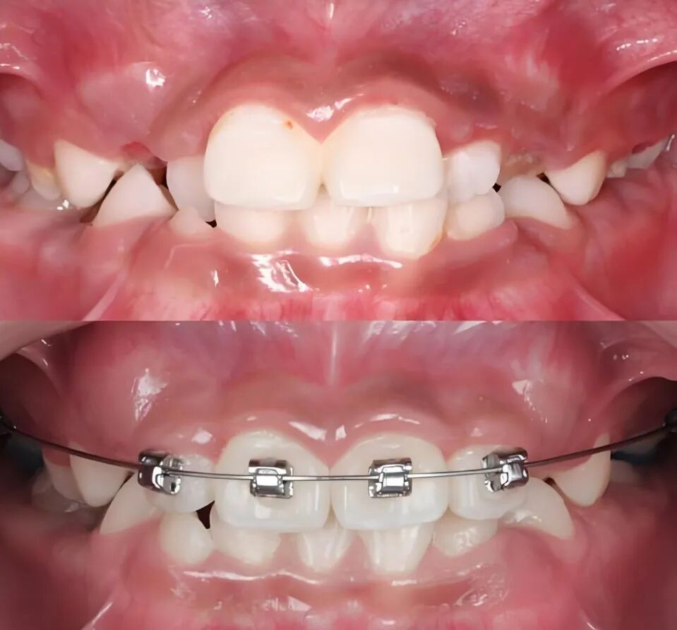 2X4矫治技术要点