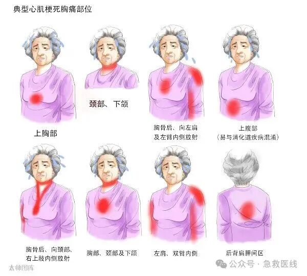 急性心肌梗死，2025最新诊疗指南总结