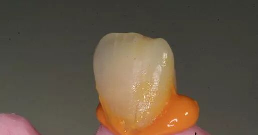 如何采用硅橡胶快速去除戴牙支点