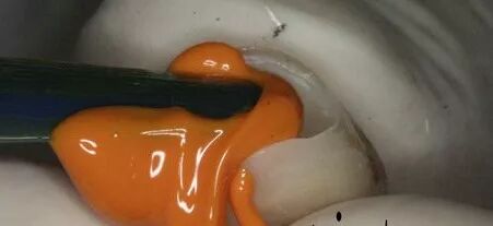 如何采用硅橡胶快速去除戴牙支点