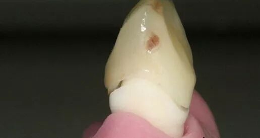 如何采用硅橡胶快速去除戴牙支点