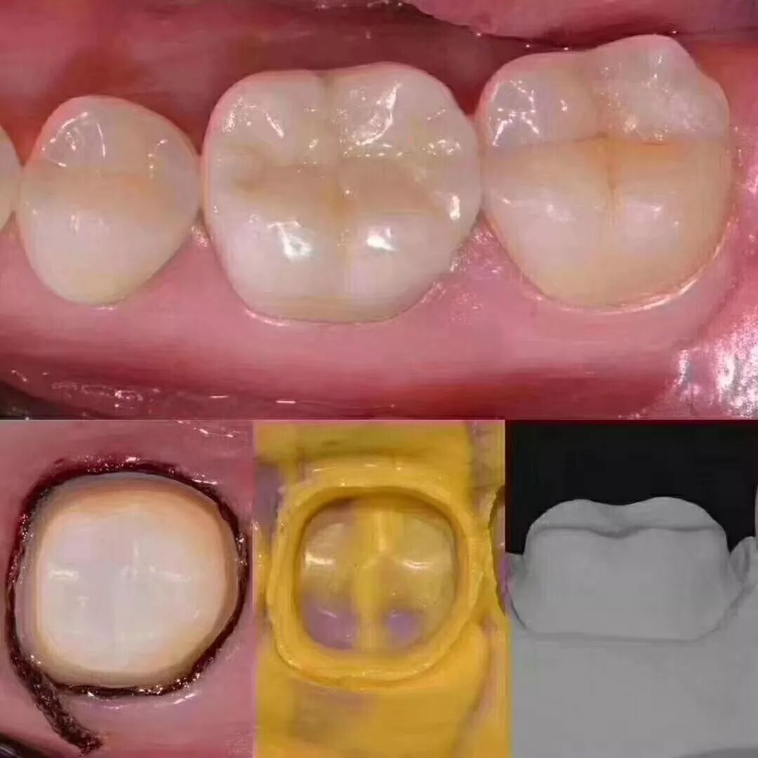 如何采用硅橡胶快速去除戴牙支点