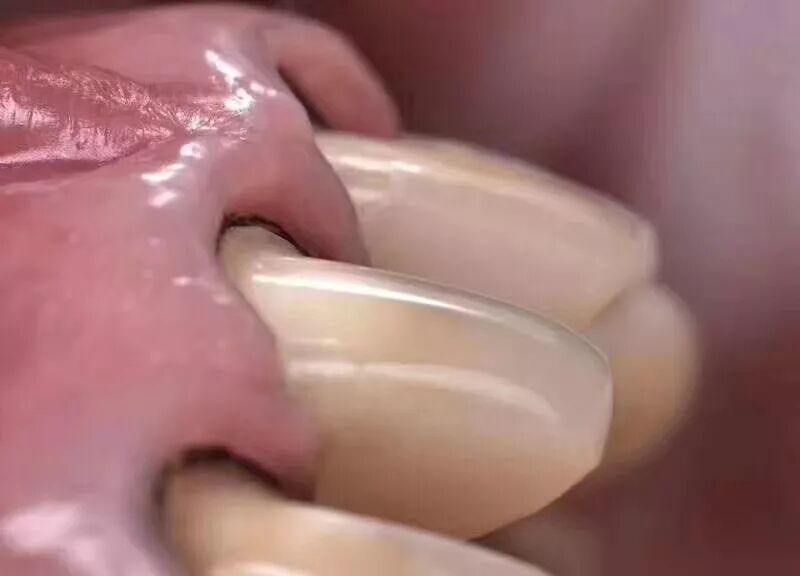 如何采用硅橡胶快速去除戴牙支点