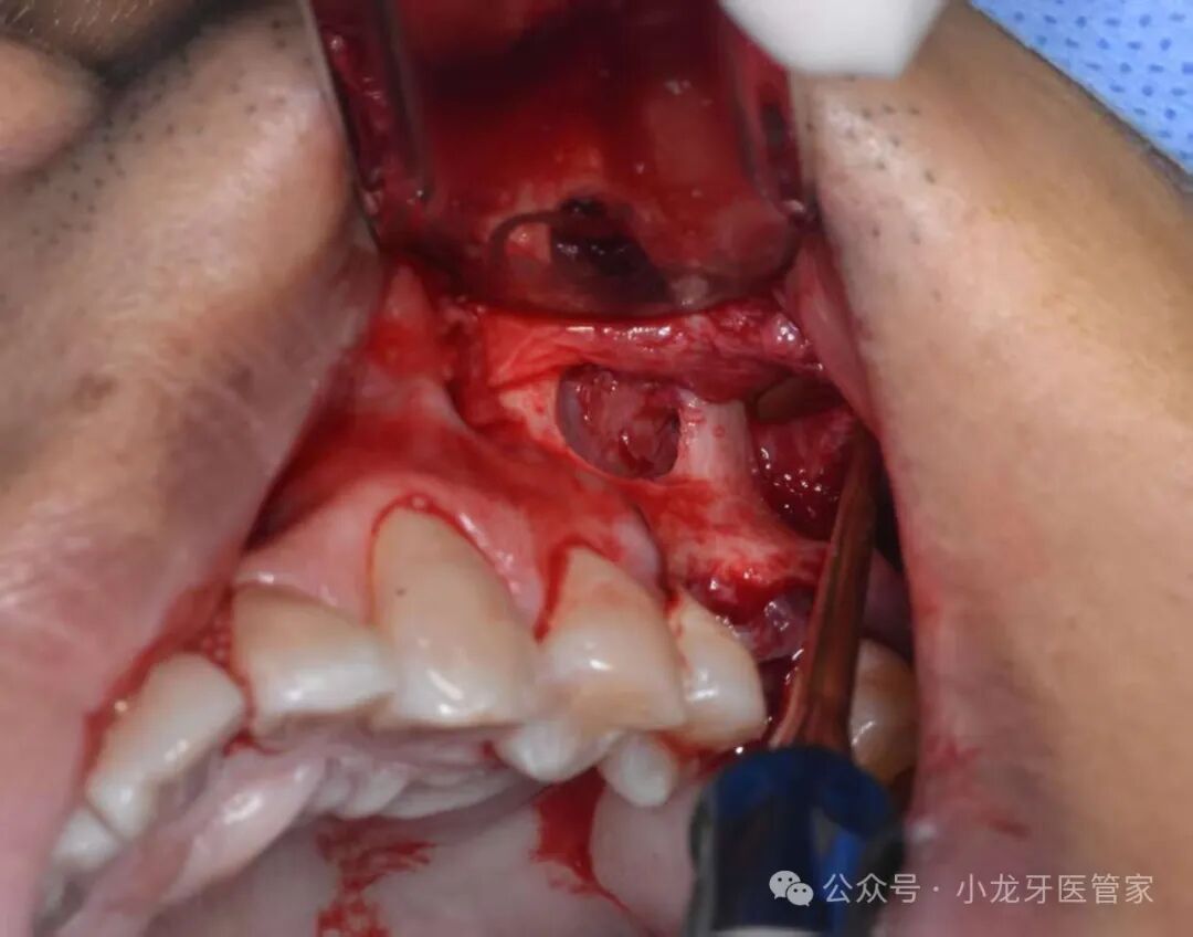 病例分享：上颌窦外提升术一例