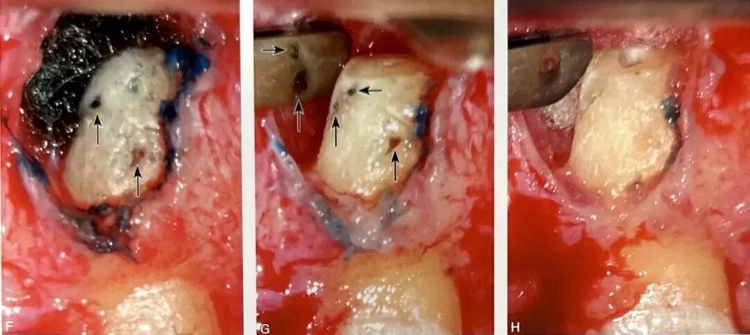 牙根纵裂的诊断和鉴别诊断
