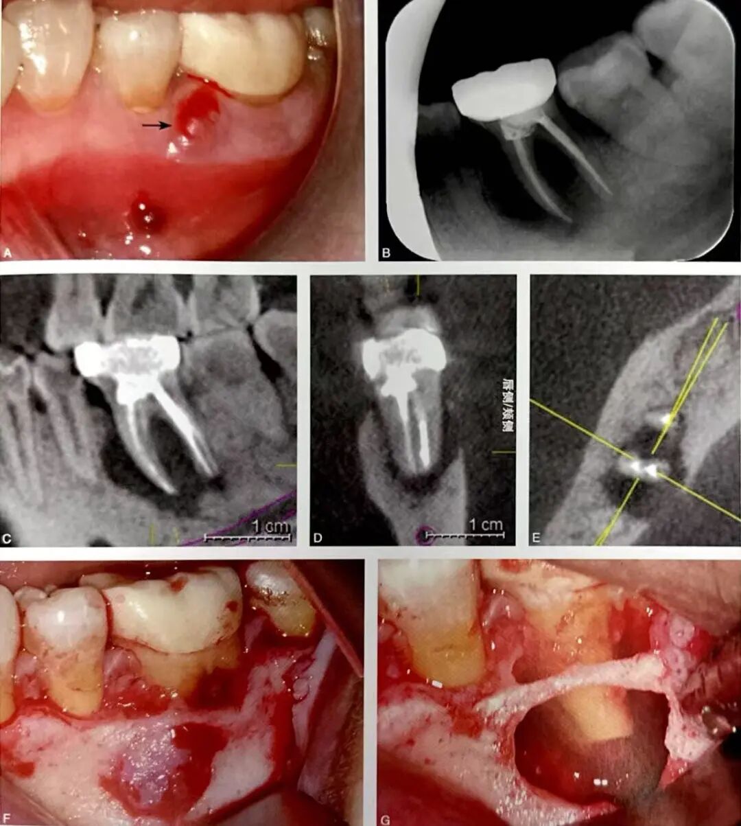 牙根纵裂的诊断和鉴别诊断