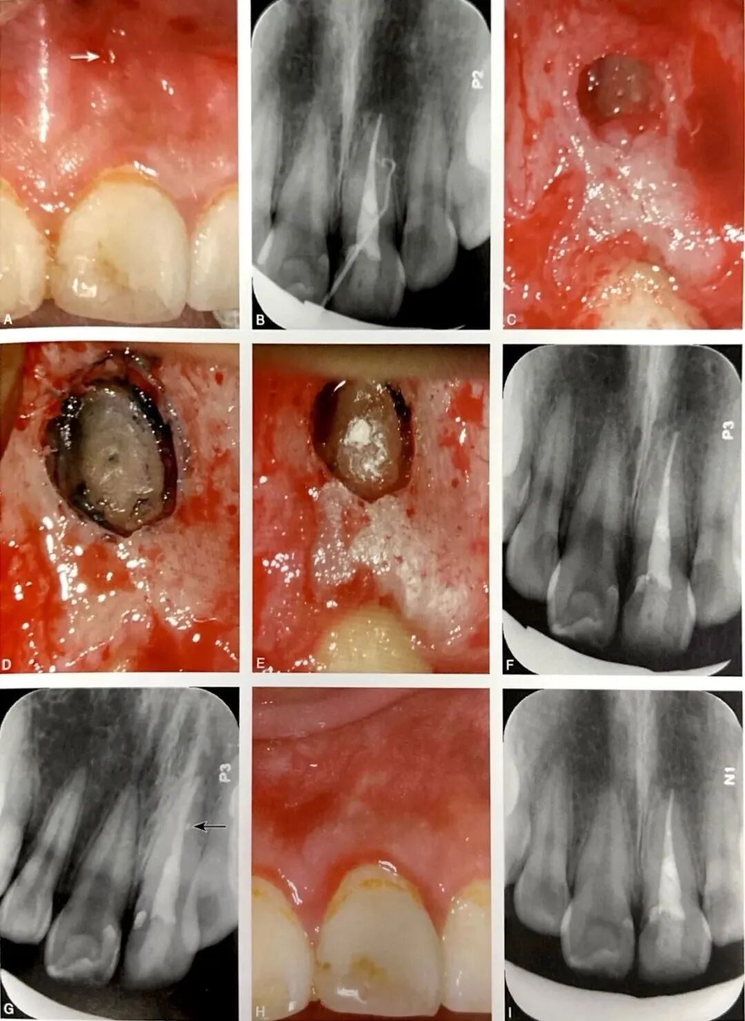 牙根纵裂的诊断和鉴别诊断