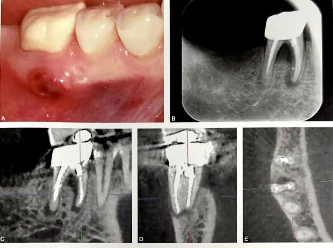 牙根纵裂的诊断和鉴别诊断
