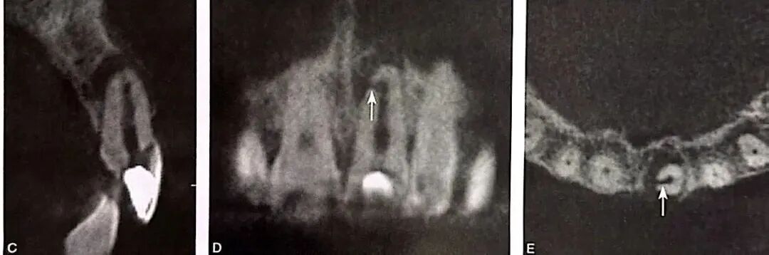 牙根纵裂的诊断和鉴别诊断