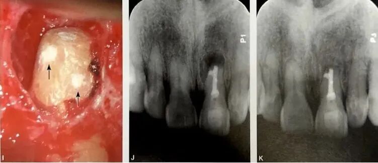 牙根纵裂的诊断和鉴别诊断