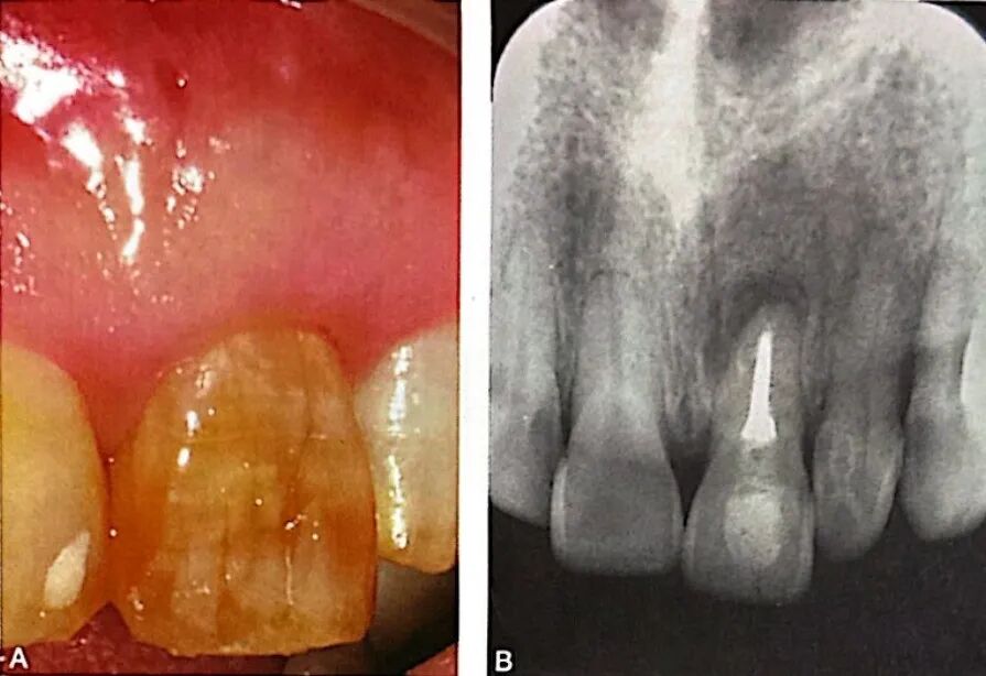 牙根纵裂的诊断和鉴别诊断
