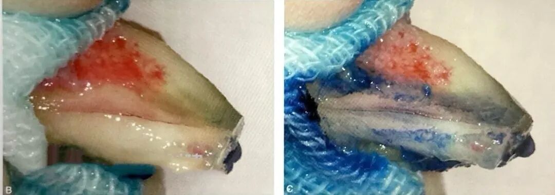 牙根纵裂的诊断和鉴别诊断