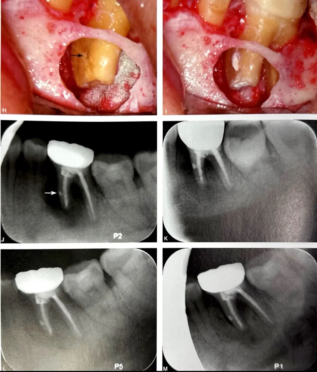 牙根纵裂的诊断和鉴别诊断