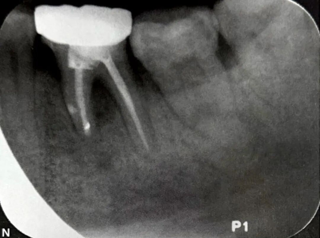 牙根纵裂的诊断和鉴别诊断