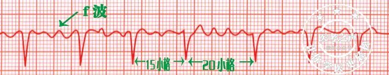常见心律失常的急诊处理（心血管医生值班必备）