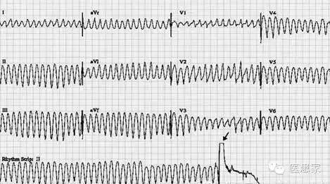 常见心律失常的急诊处理（心血管医生值班必备）