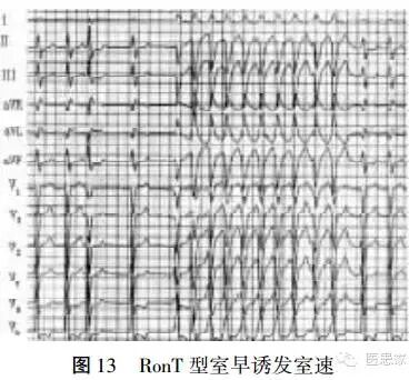 常见心律失常的急诊处理（心血管医生值班必备）