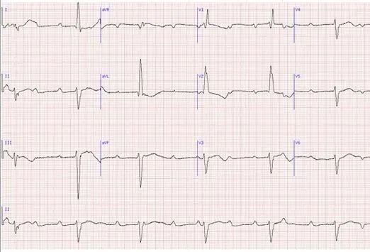 常见心律失常的急诊处理（心血管医生值班必备）