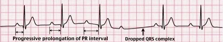 常见心律失常的急诊处理（心血管医生值班必备）