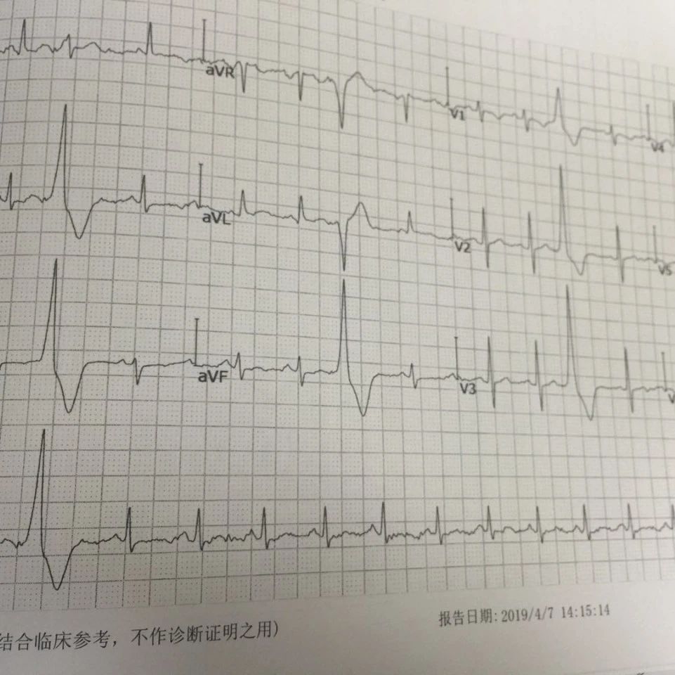 如果早搏治不好，后期发展会严重吗？