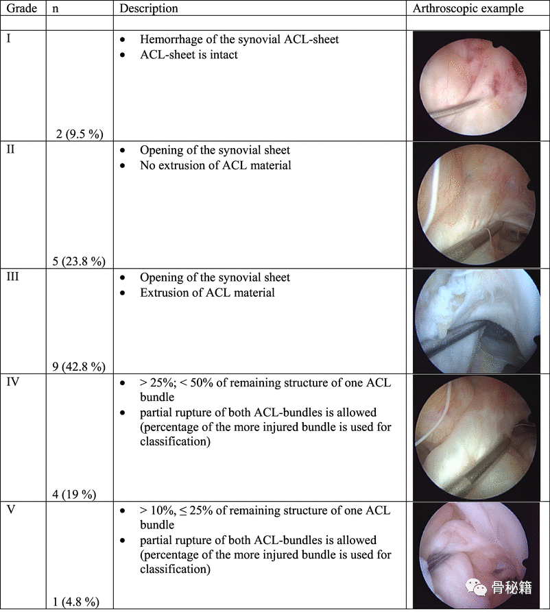 ACL前叉韧带损伤的分度、分型与治疗