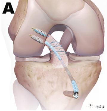 ACL前叉韧带损伤的分度、分型与治疗