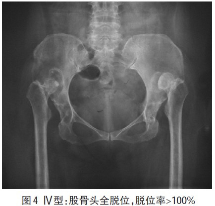 s拉钩怎么用髋关节脱位快速诊治的关键技巧，此文必看！-AED除颤器产品网