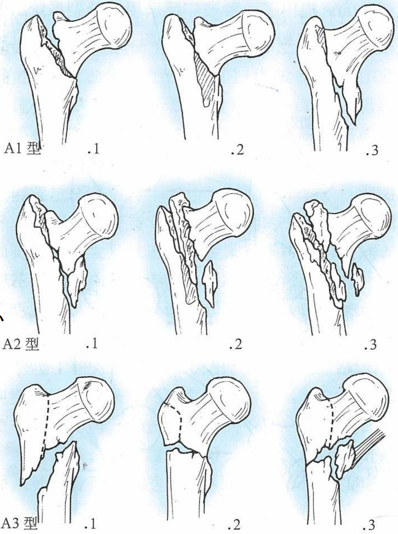 股骨粗隆间骨折的分型与临床诊治