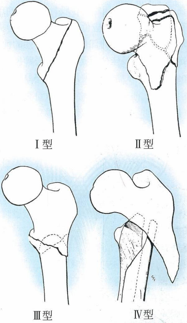 股骨粗隆间骨折的分型与临床诊治