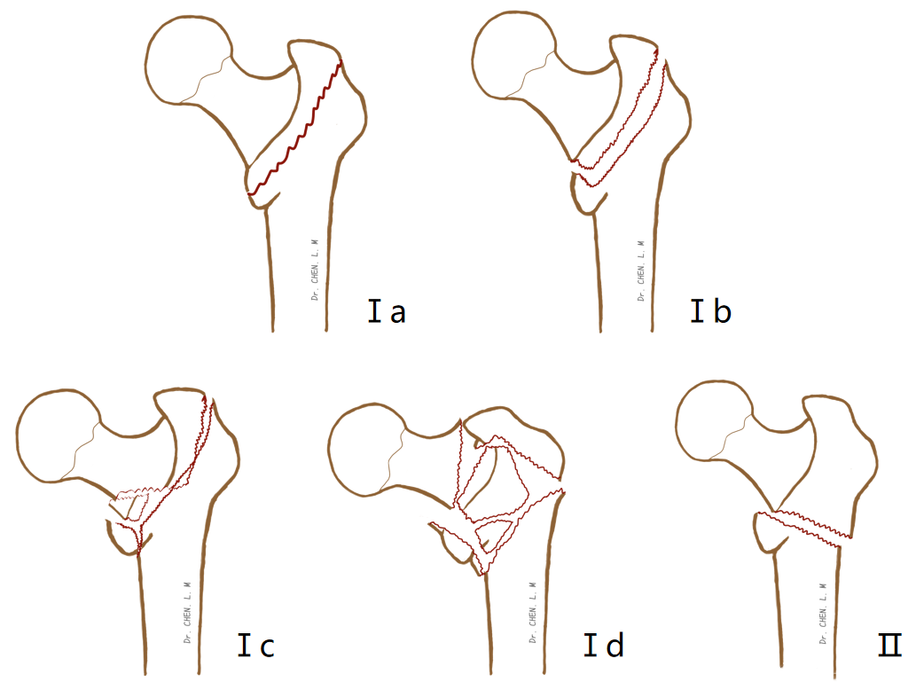 股骨粗隆间骨折的分型与临床诊治