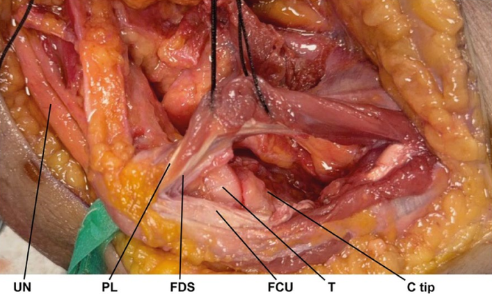 冠突骨折的解剖特点、分型与6种内侧手术入路